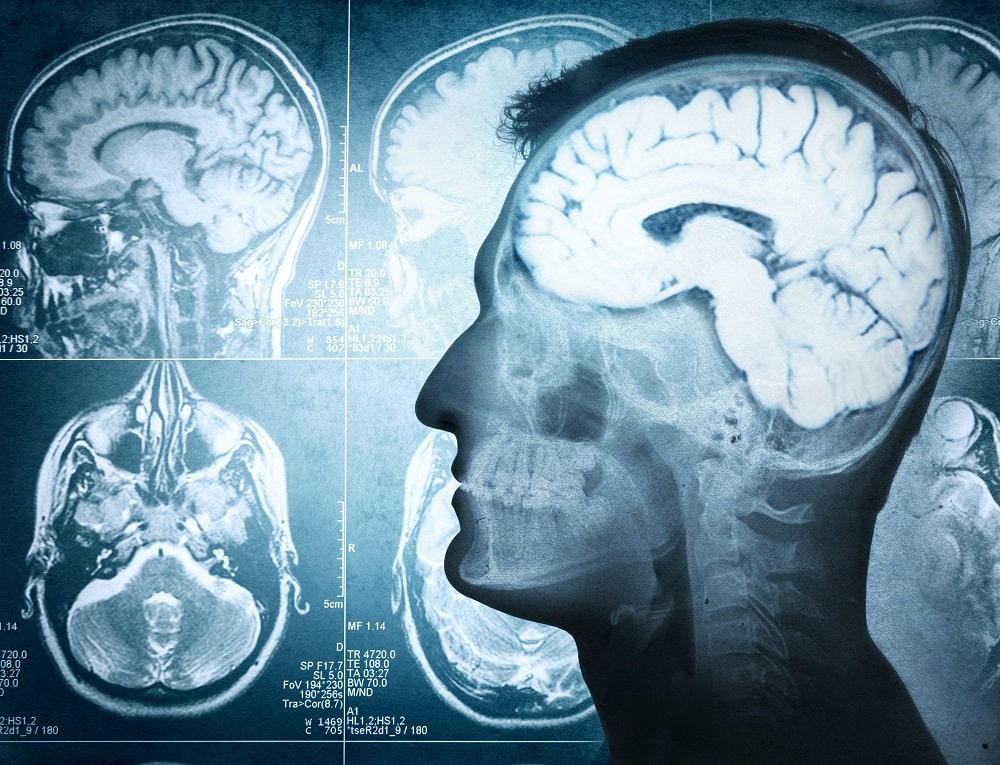 Boost Brain Potential with Nootropics